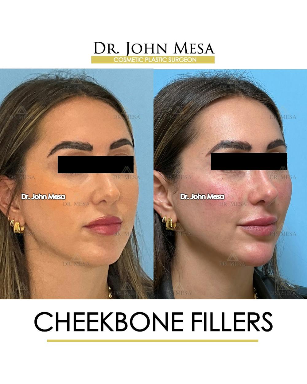 Cheekbone Filler Before & After Gallery - Patient 149097956 - Image 2