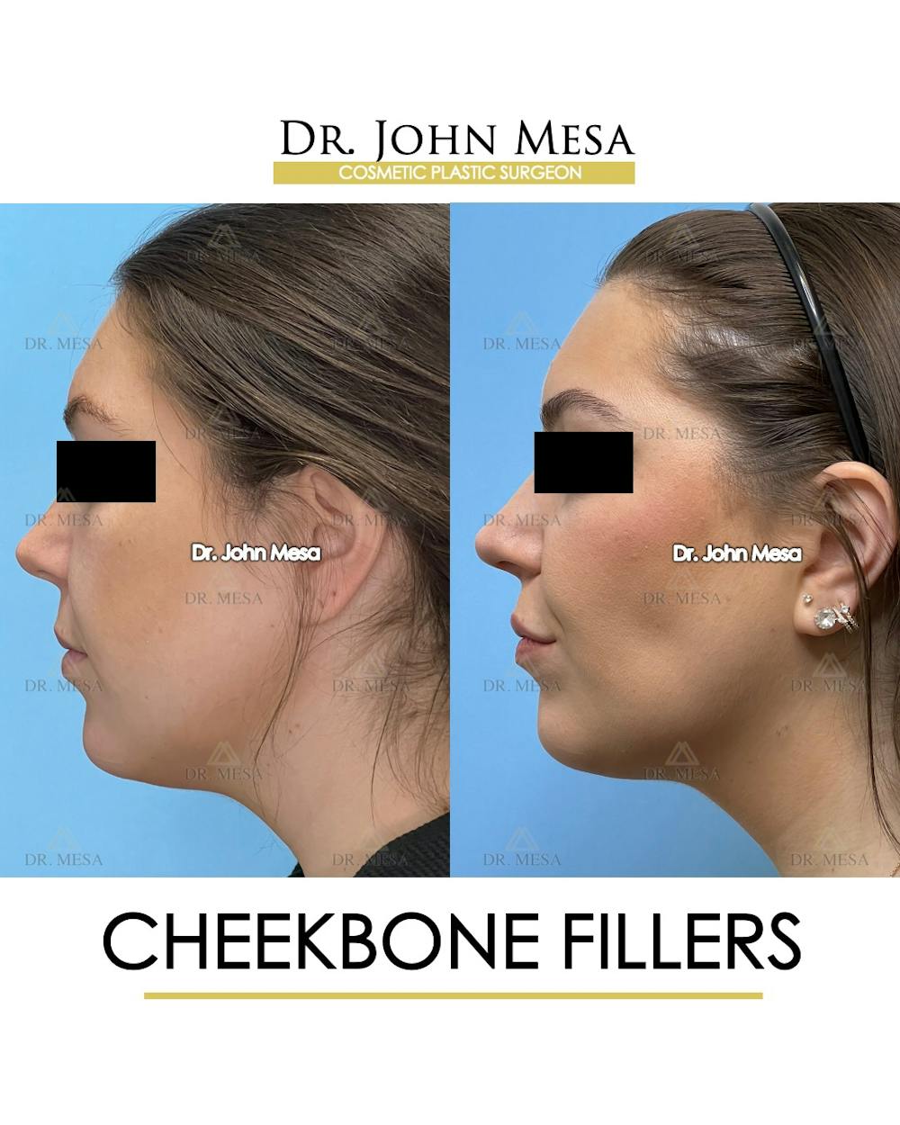 Cheekbone Filler Before & After Gallery - Patient 149097957 - Image 5