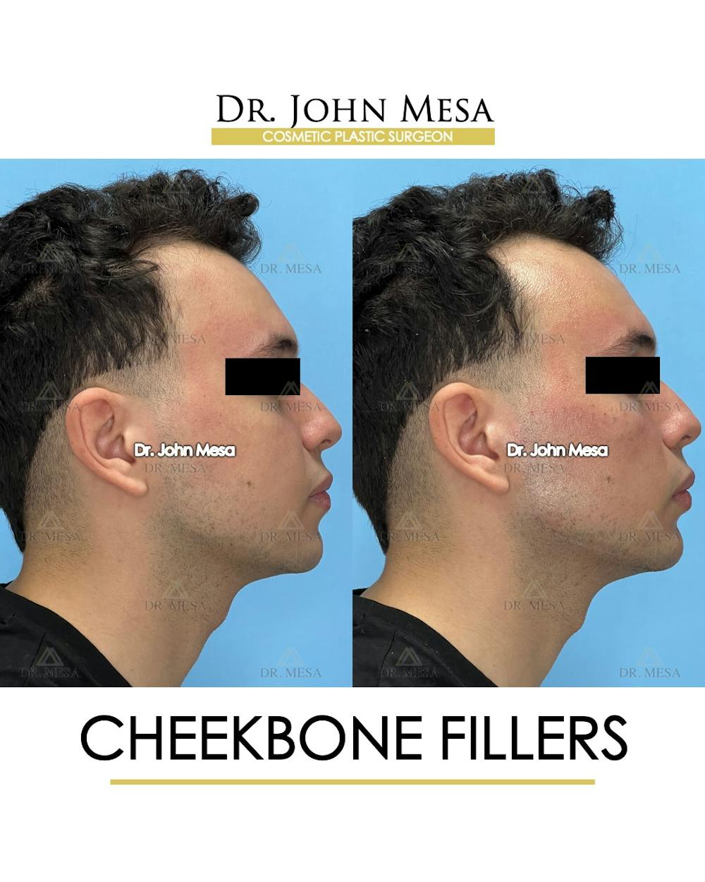 Cheekbone Filler Before & After Gallery - Patient 149097961 - Image 3