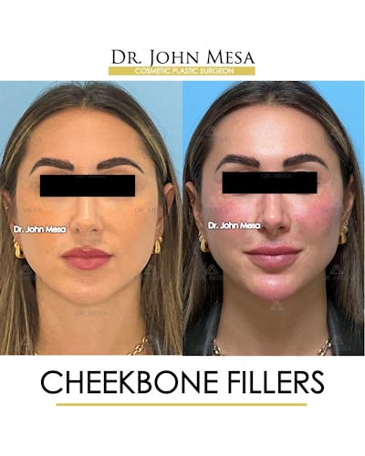 Cheekbone Filler Before & After Gallery - Patient 149097956 - Image 1