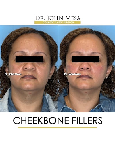 Cheekbone Filler Before & After Gallery - Patient 149097954 - Image 1