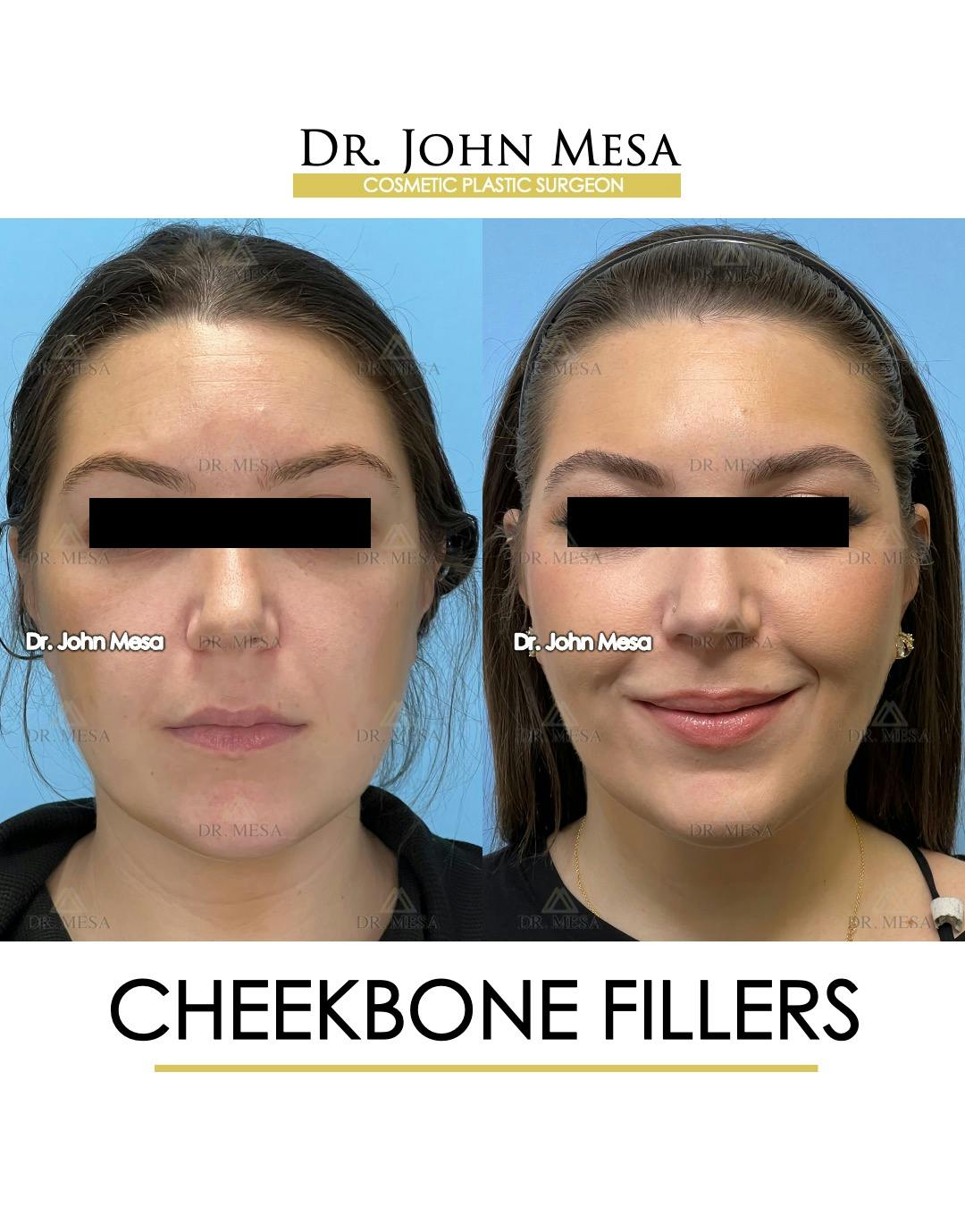 Cheekbone Filler Before & After Gallery - Patient 149097957 - Image 1