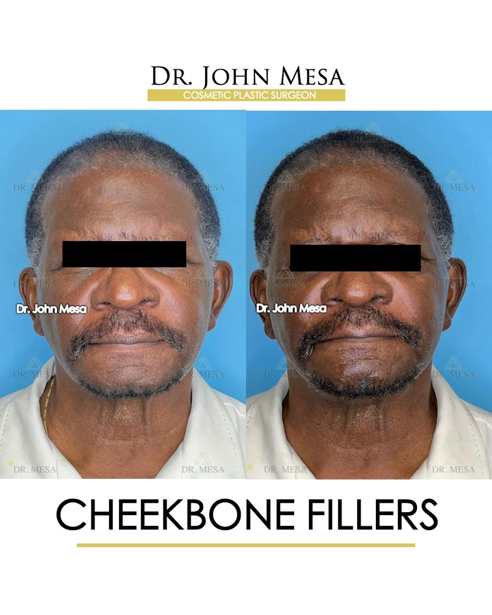 Cheekbone Filler Before & After Gallery - Patient 149097959 - Image 1