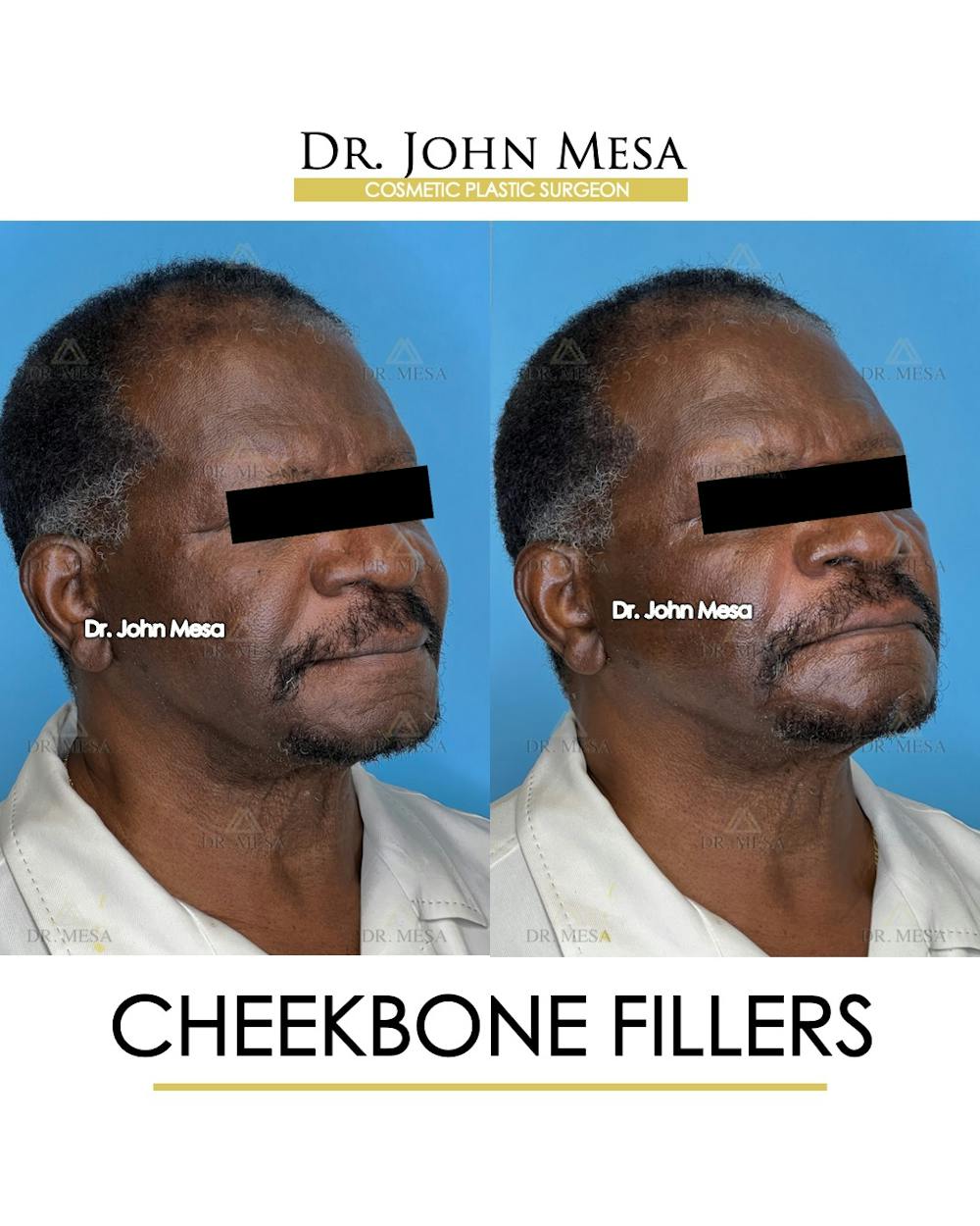 Cheekbone Filler Before & After Gallery - Patient 149097959 - Image 2