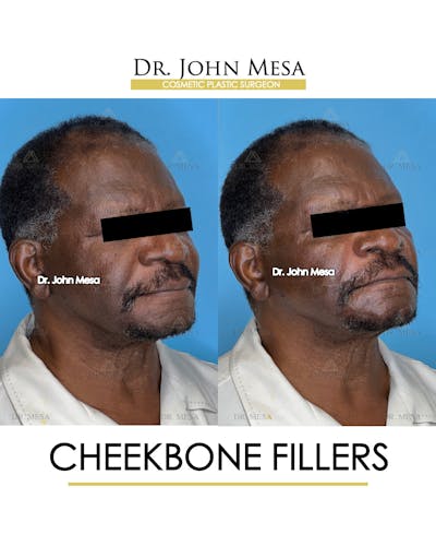 Cheekbone Filler Before & After Gallery - Patient 149097959 - Image 2