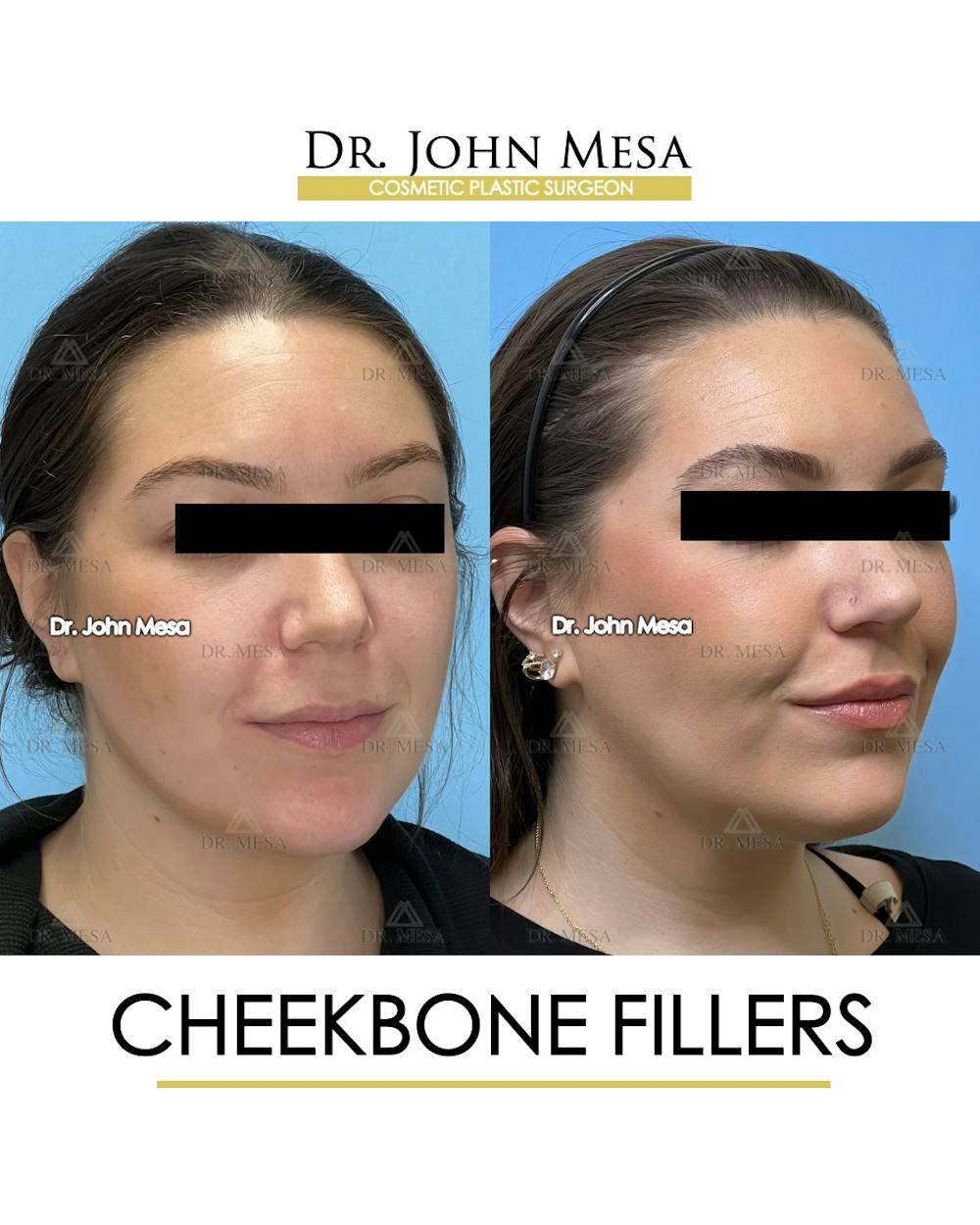 Cheekbone Filler Before & After Gallery - Patient 149097957 - Image 2