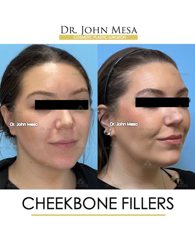 Cheekbone Filler Before & After Gallery - Patient 149097957 - Image 2