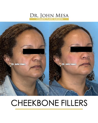 Cheekbone Filler Before & After Gallery - Patient 149097954 - Image 2