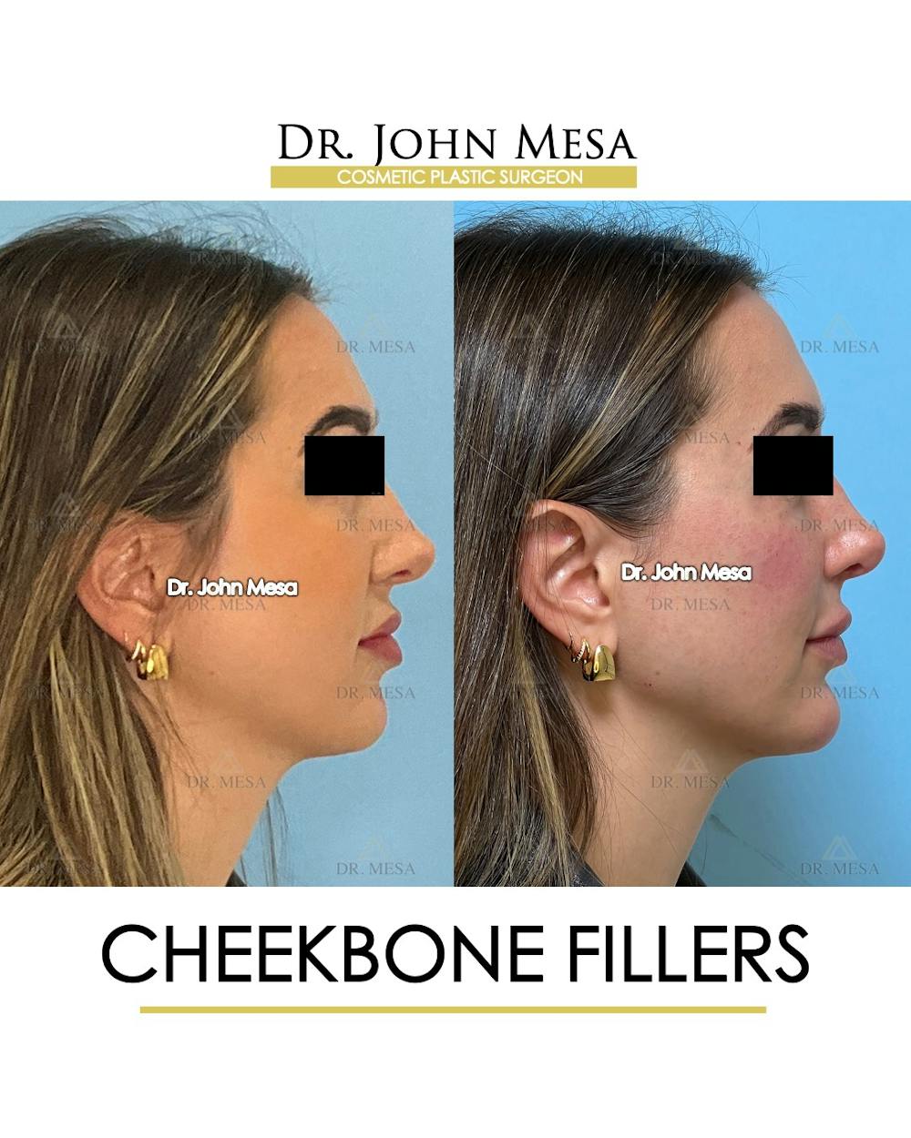 Cheekbone Filler Before & After Gallery - Patient 149097956 - Image 4