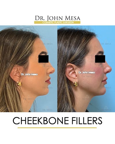 Cheekbone Filler Before & After Gallery - Patient 149097956 - Image 4