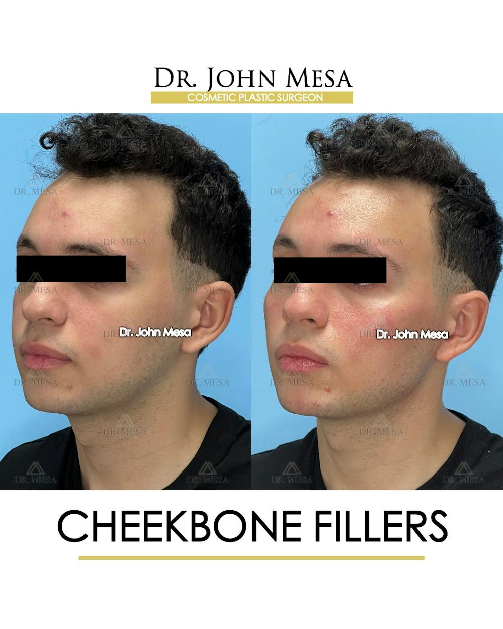 Cheekbone Filler Before & After Gallery - Patient 149097961 - Image 4