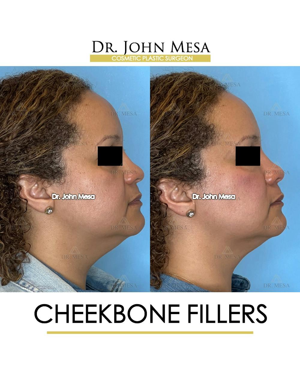 Cheekbone Filler Before & After Gallery - Patient 149097954 - Image 3