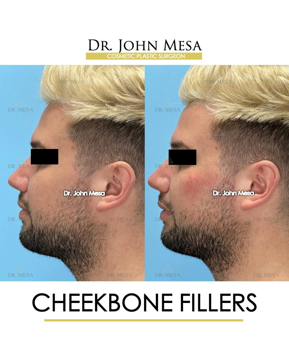 Cheekbone Filler Before & After Gallery - Patient 149097960 - Image 5