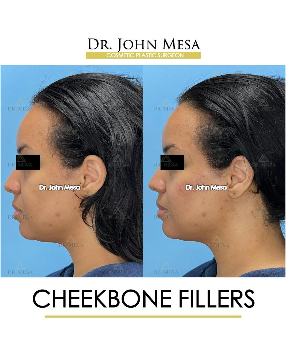 Cheekbone Filler Before & After Gallery - Patient 149097955 - Image 5
