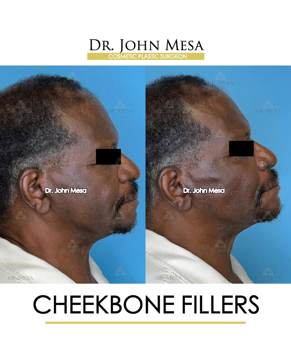 Cheekbone Filler Before & After Gallery - Patient 149097959 - Image 3