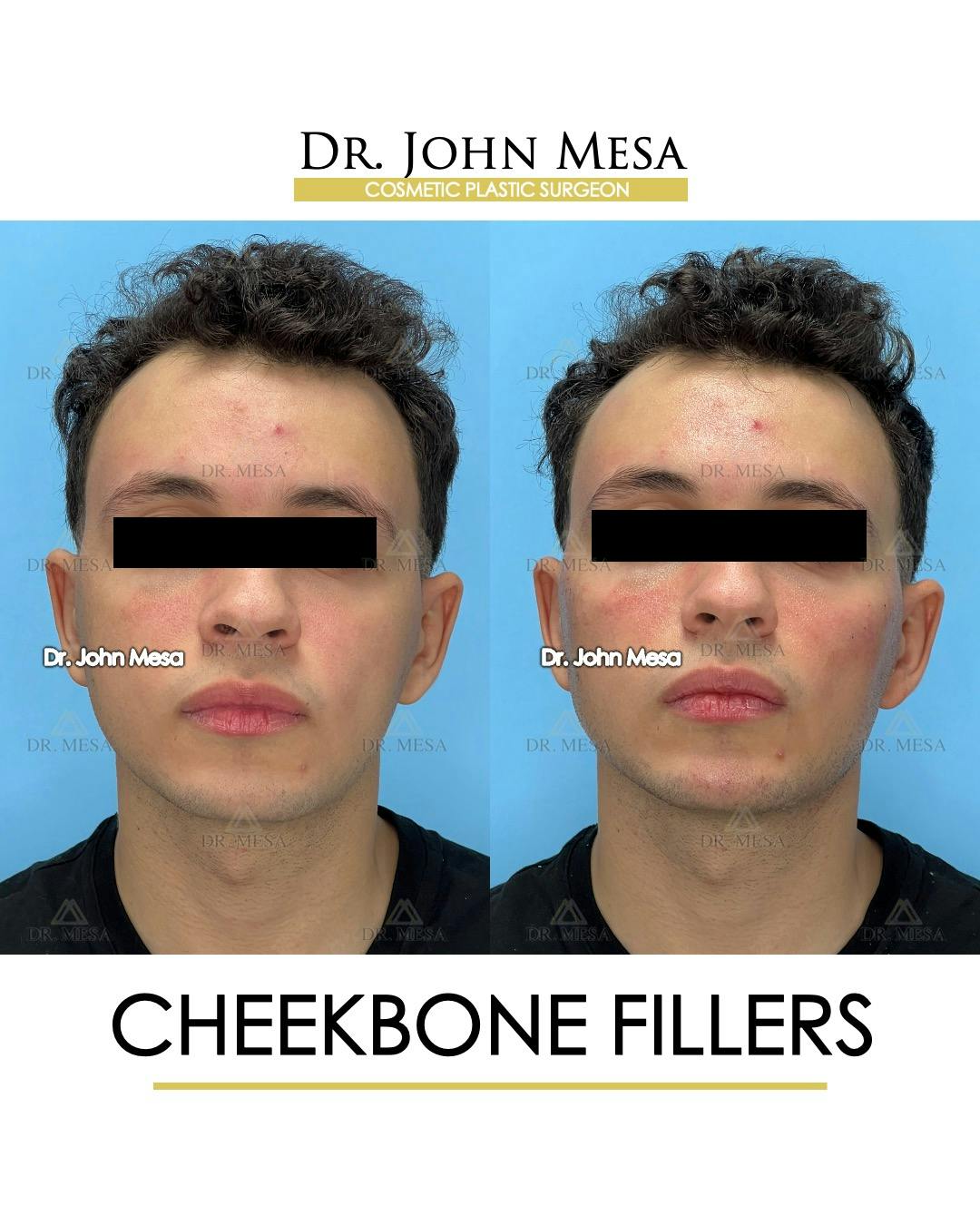 Cheekbone Filler Before & After Gallery - Patient 149097961 - Image 1