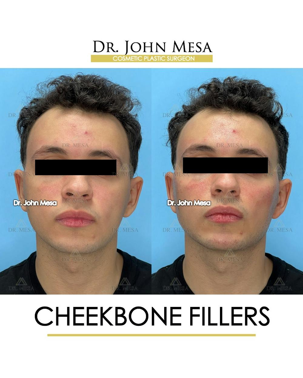 Cheekbone Filler Before & After Gallery - Patient 149097961 - Image 1