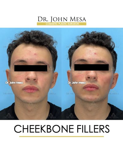 Cheekbone Filler Before & After Gallery - Patient 149097961 - Image 1