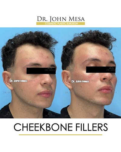 Cheekbone Filler Before & After Gallery - Patient 149097961 - Image 2
