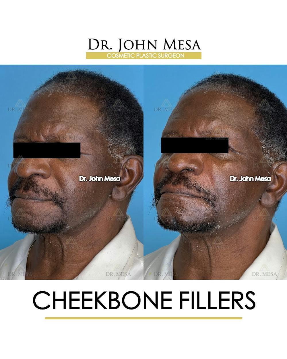 Cheekbone Filler Before & After Gallery - Patient 149097959 - Image 4