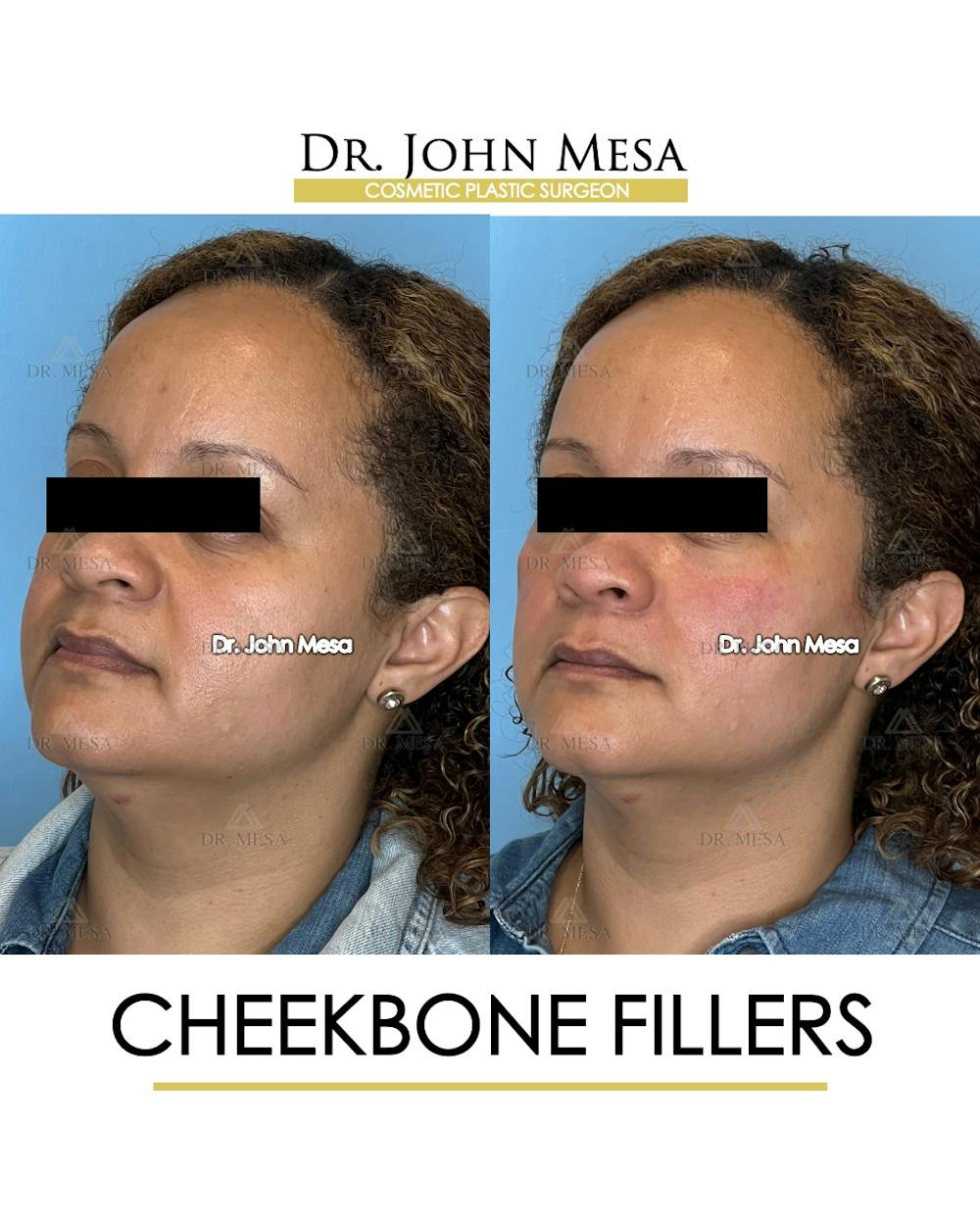 Cheekbone Filler Before & After Gallery - Patient 149097954 - Image 4