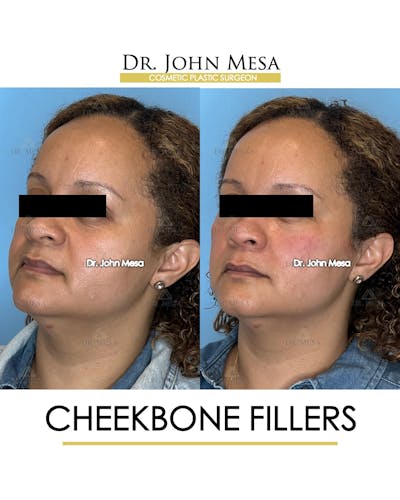Cheekbone Filler Before & After Gallery - Patient 149097954 - Image 4
