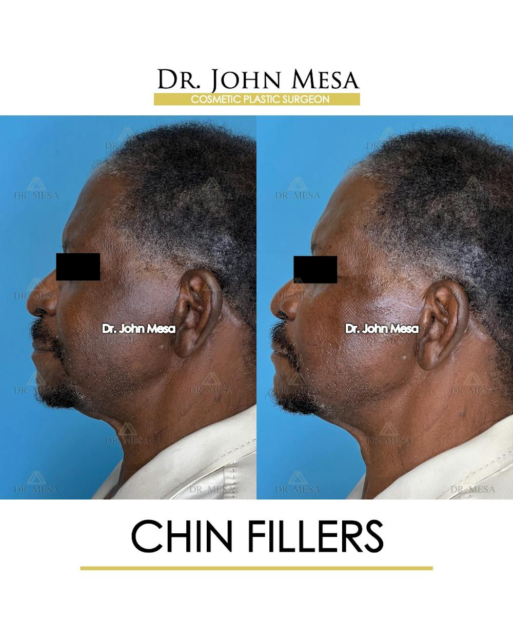 Chin Filler Before & After Gallery - Patient 149284280 - Image 5