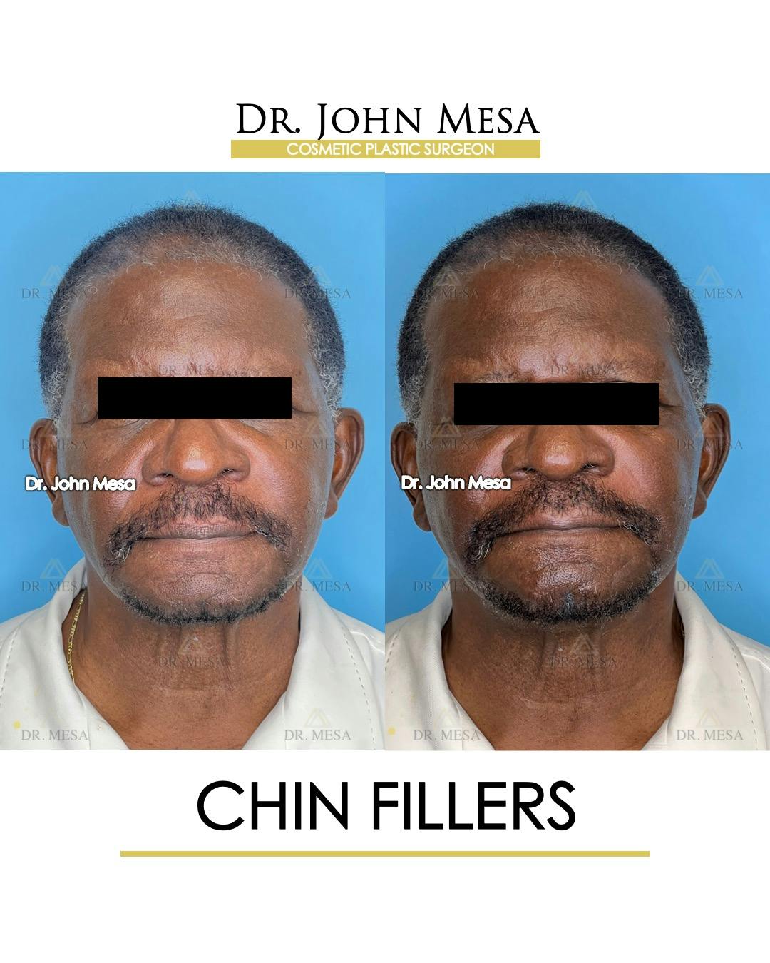 Chin Filler Before & After Gallery - Patient 149284280 - Image 1