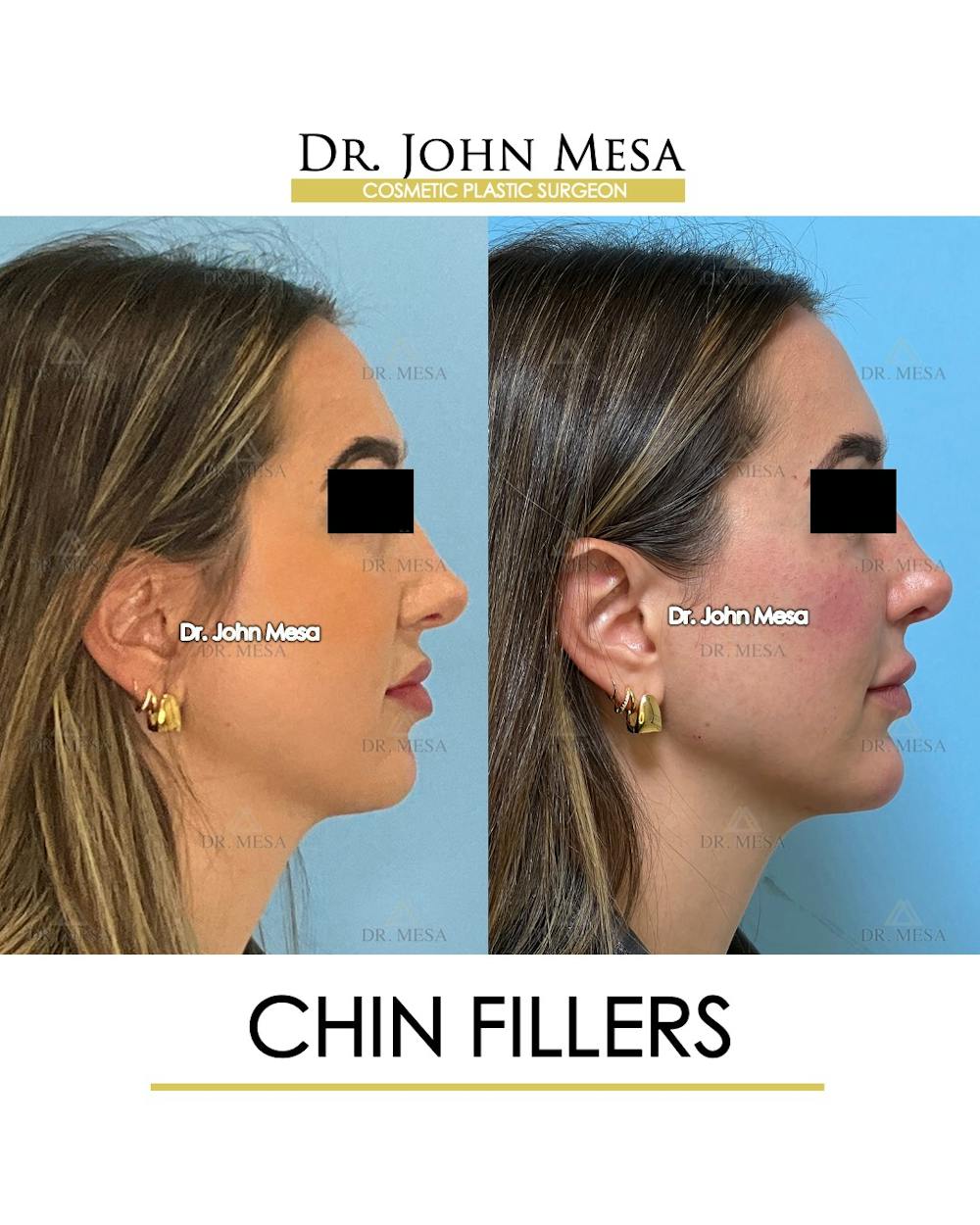 Chin Filler Before & After Gallery - Patient 149097962 - Image 4