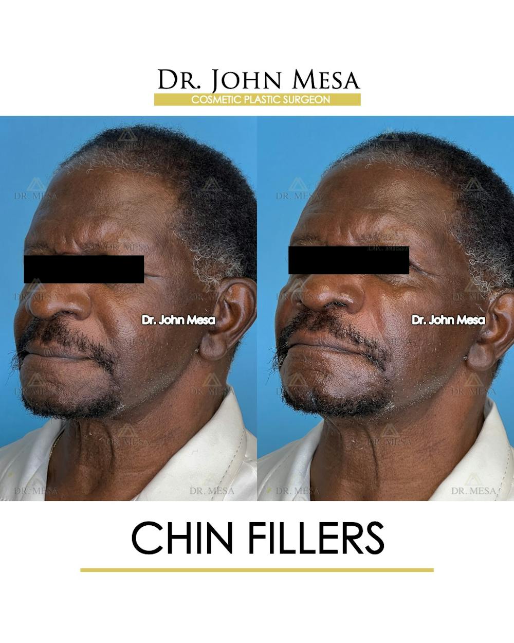 Chin Filler Before & After Gallery - Patient 149284280 - Image 4