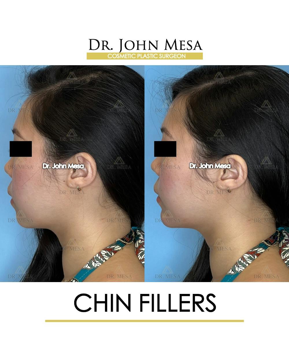 Chin Filler Before & After Gallery - Patient 149097963 - Image 5