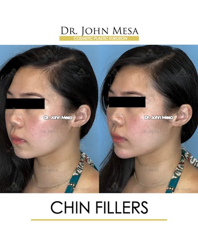 Chin Filler Before & After Gallery - Patient 149097963 - Image 4