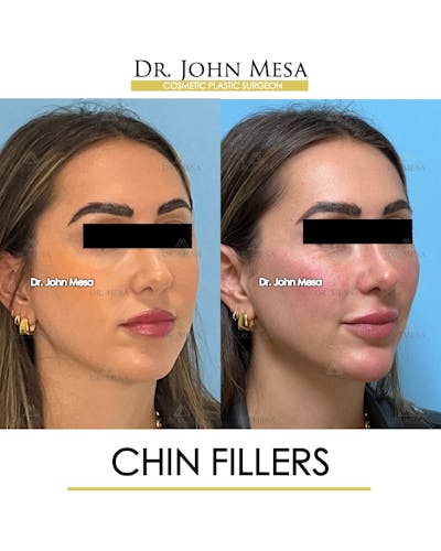 Chin Filler Before & After Gallery - Patient 149097962 - Image 2