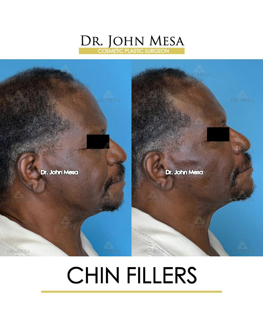 Chin Filler Before & After Gallery - Patient 149284280 - Image 3