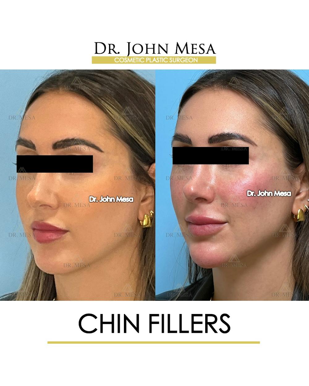 Chin Filler Before & After Gallery - Patient 149097962 - Image 3
