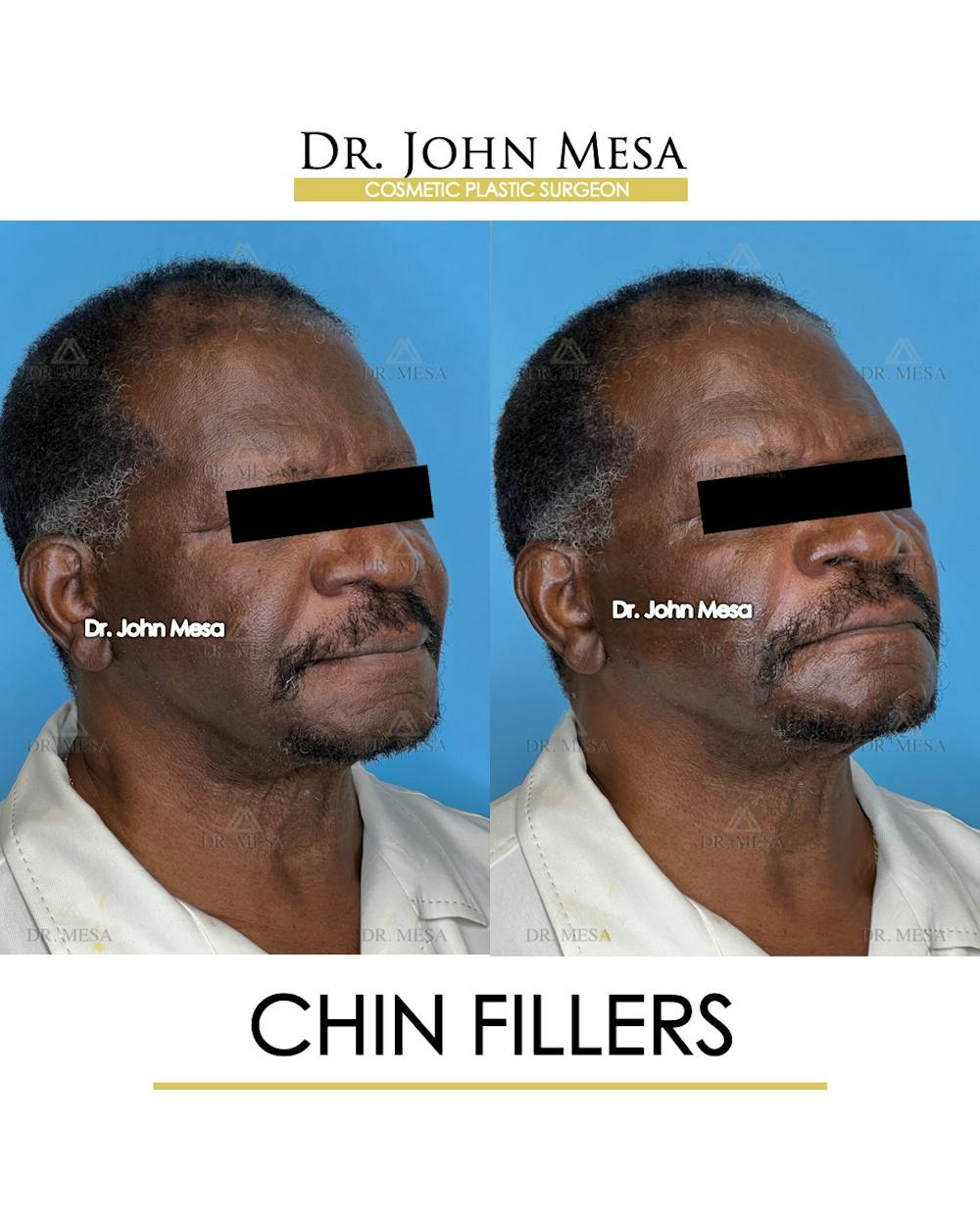 Chin Filler Before & After Gallery - Patient 149284280 - Image 2