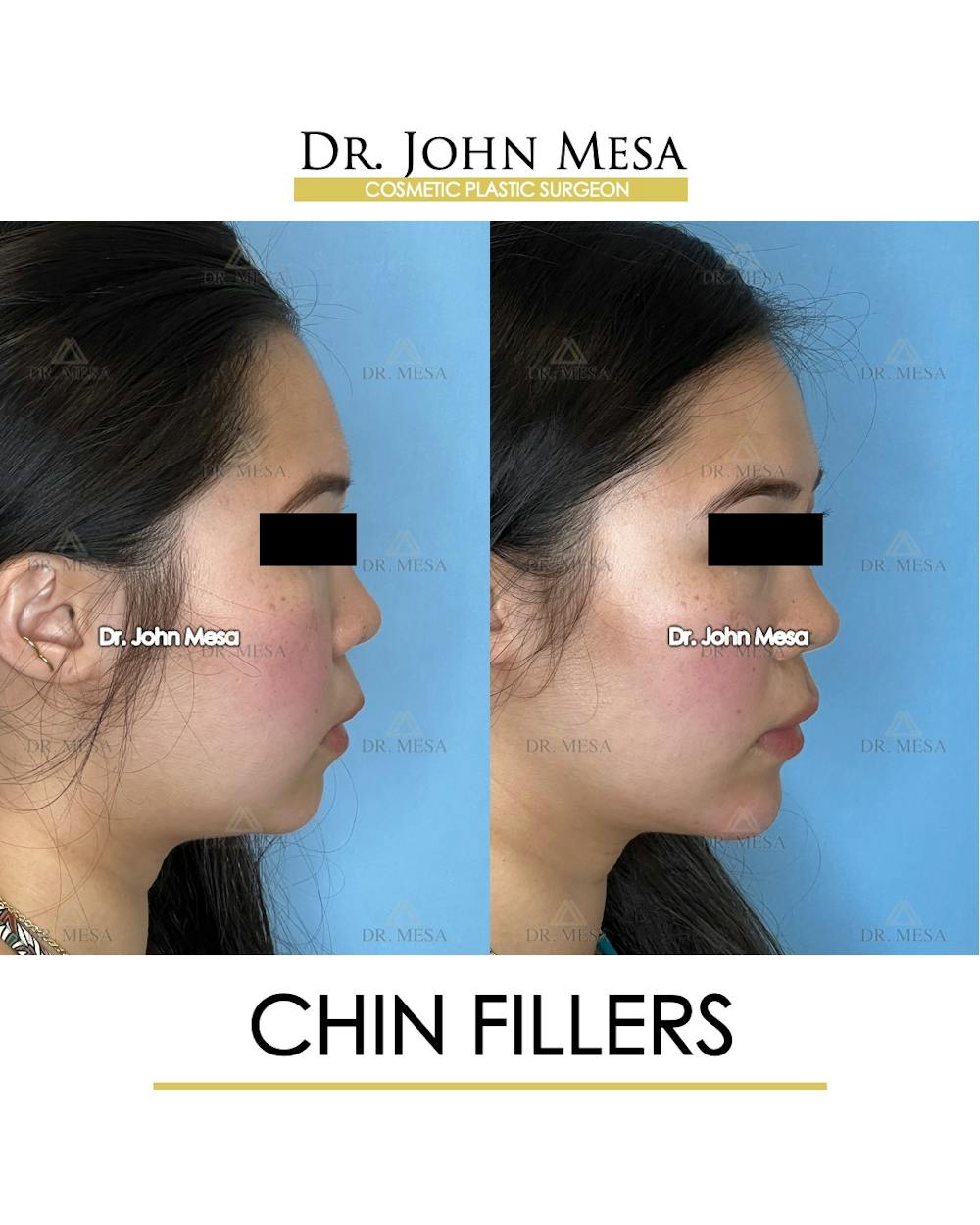 Chin Filler Before & After Gallery - Patient 149097963 - Image 3