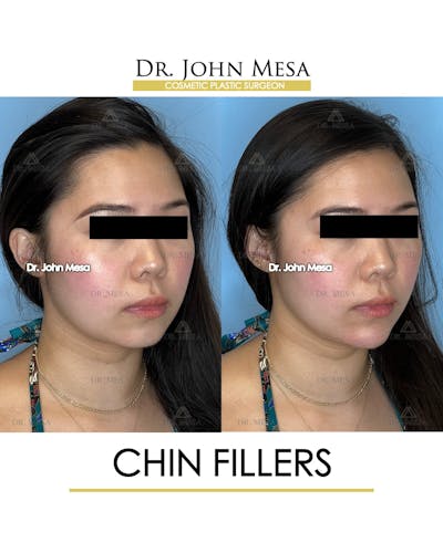 Chin Filler Before & After Gallery - Patient 149097963 - Image 2
