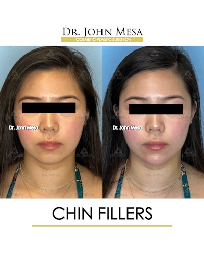 Chin Filler Before & After Gallery - Patient 149097963 - Image 1