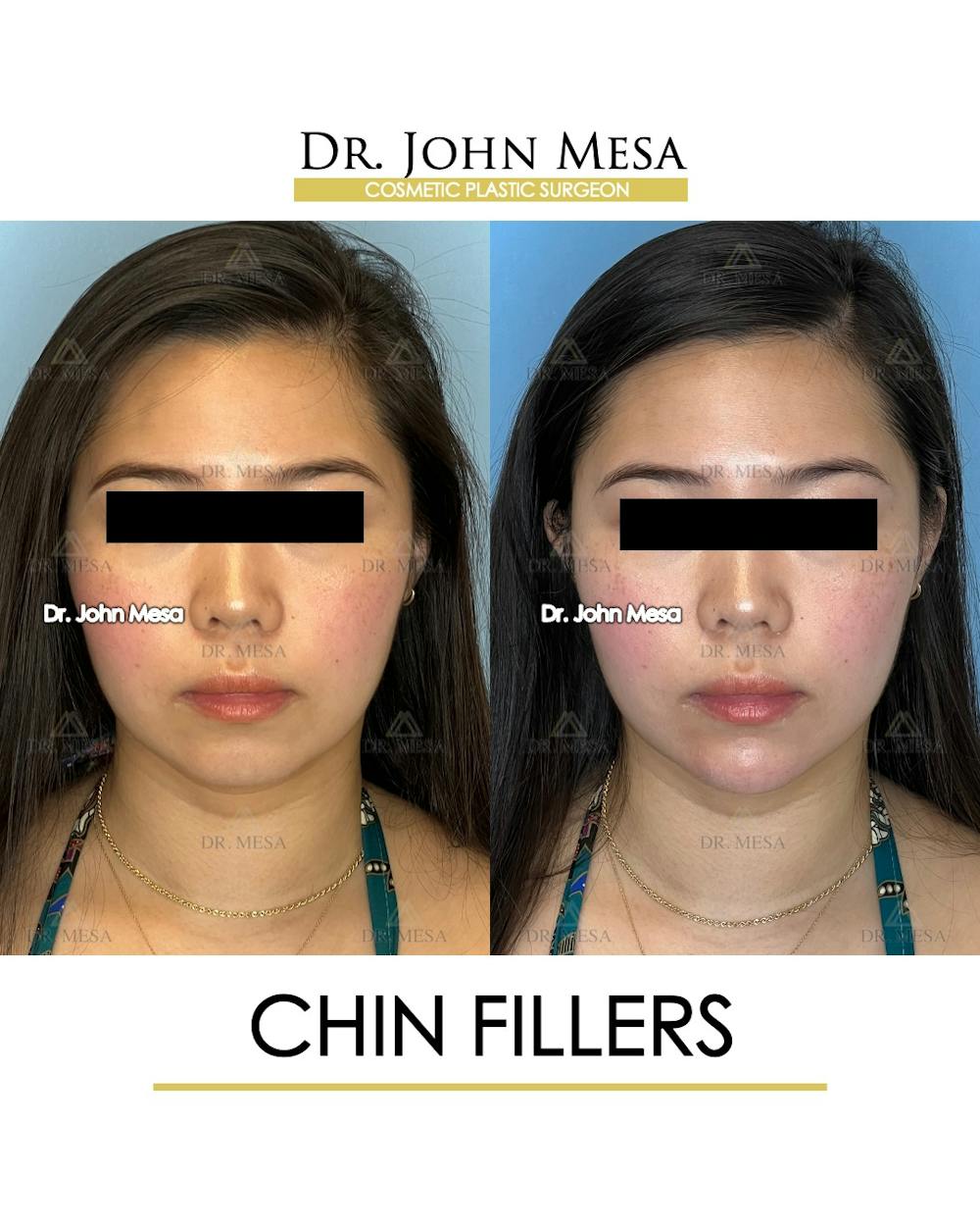 Chin Filler Before & After Gallery - Patient 149097963 - Image 1
