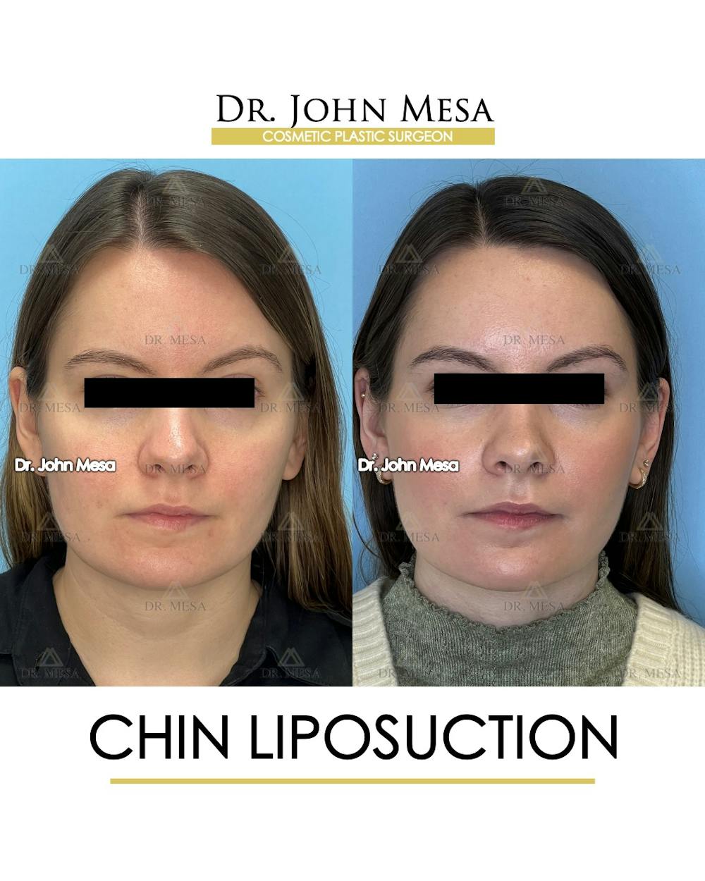Chin Liposuction Before & After Gallery - Patient 149097966 - Image 1