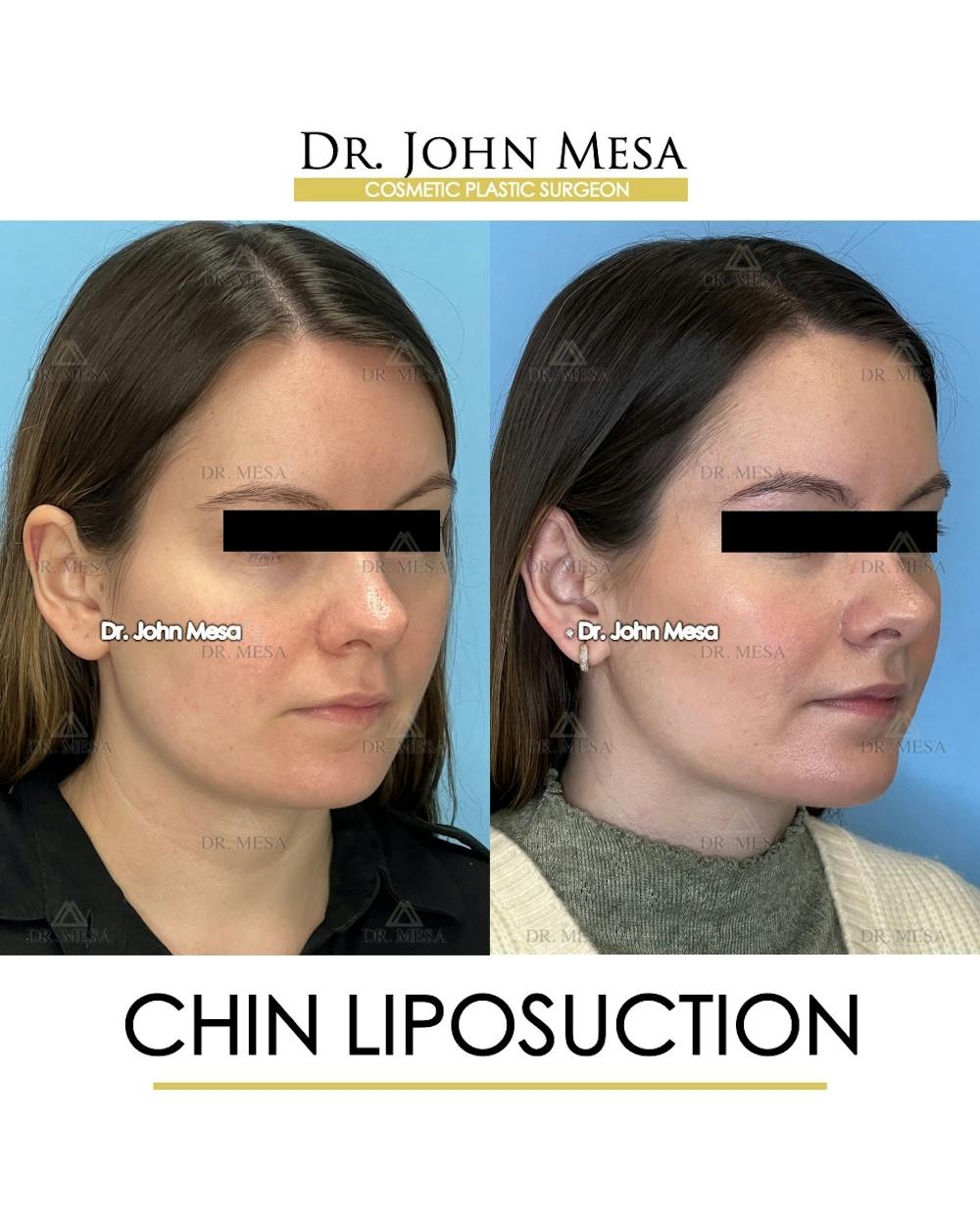 Chin Liposuction Before & After Gallery - Patient 149097966 - Image 3