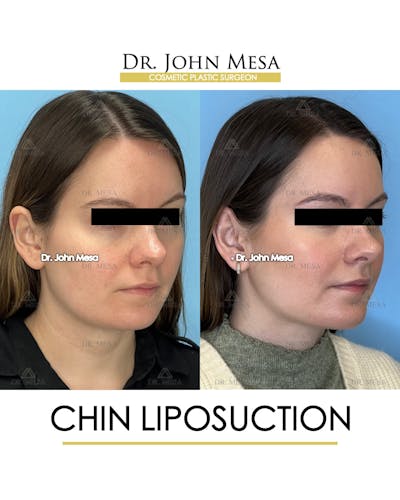 Chin Liposuction Before & After Gallery - Patient 149097966 - Image 2