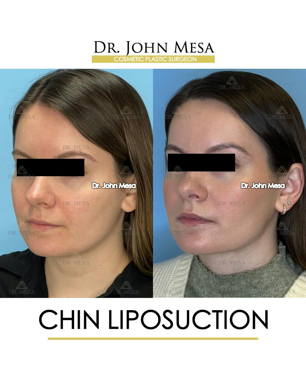 Chin Liposuction Before & After Gallery - Patient 149097966 - Image 3