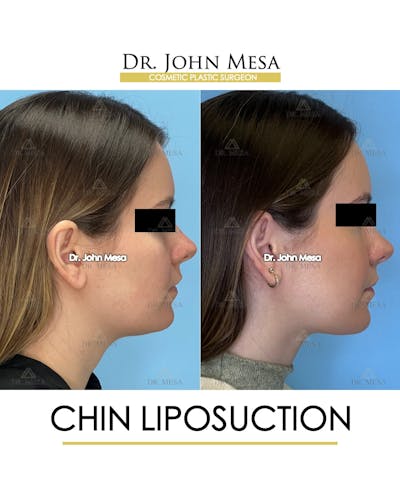 Chin Liposuction Before & After Gallery - Patient 149097966 - Image 1