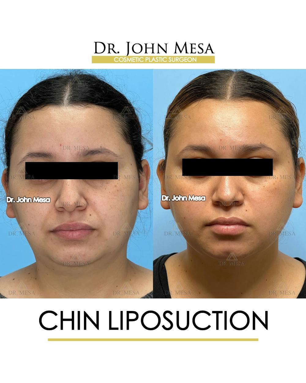Chin Liposuction Before & After Gallery - Patient 149097967 - Image 2
