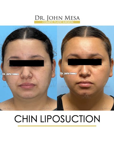 Chin Liposuction Before & After Gallery - Patient 149097967 - Image 1