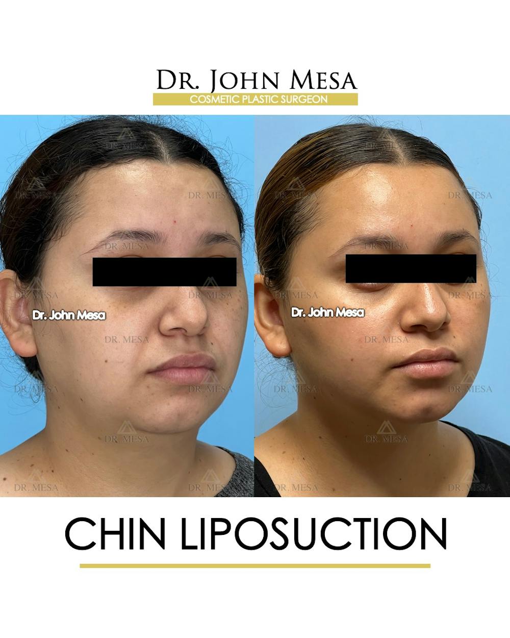 Chin Liposuction Before & After Gallery - Patient 149097967 - Image 3