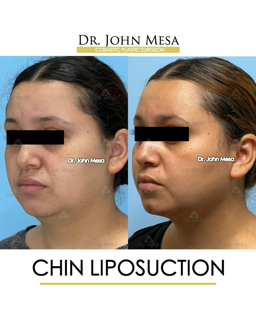 Chin Liposuction Before & After Gallery - Patient 149097967 - Image 4
