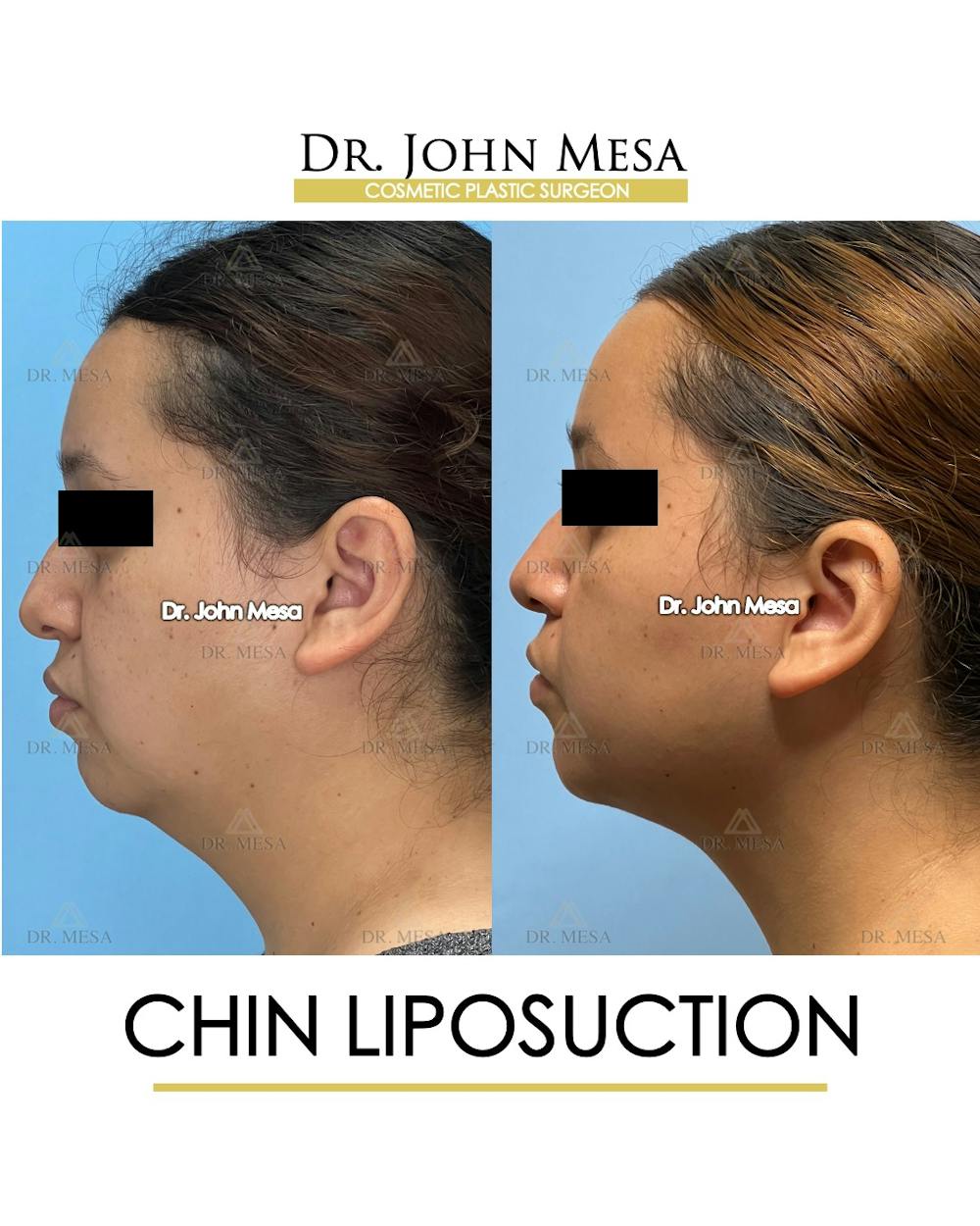 Chin Liposuction Before & After Gallery - Patient 149097967 - Image 5